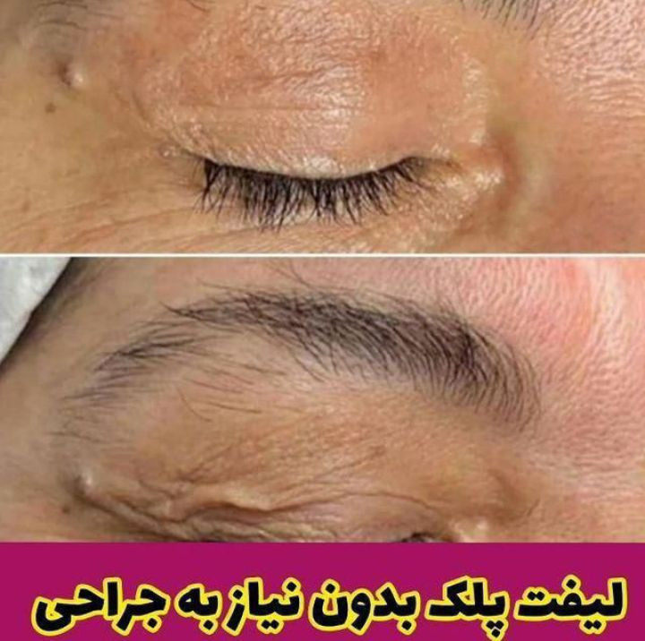 کرم جوانسازی و لیفتینگ لاکچری کوین